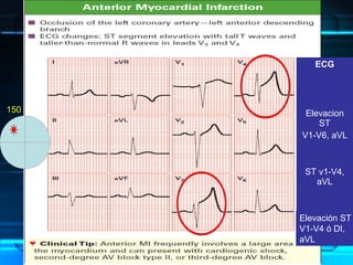 ECG
Elevacion
ST
V1-V6, aVL
ST v1-V4,
aVL
Elevación ST
V1-V4 ó DI,
aVL
-150
 