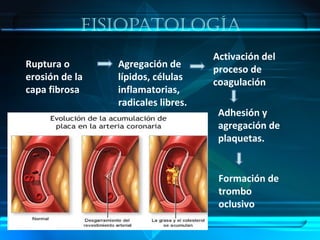 fisiopaTología
Ruptura o
erosión de la
capa fibrosa
Agregación de
lípidos, células
inflamatorias,
radicales libres.
Activación del
proceso de
coagulación
Formación de
trombo
oclusivo
Adhesión y
agregación de
plaquetas.
 