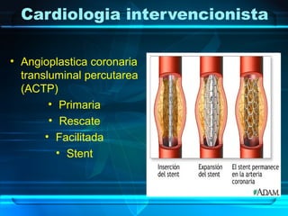 Cardiologia intervencionista
• Angioplastica coronaria
transluminal percutarea
(ACTP)
• Primaria
• Rescate
• Facilitada
• Stent
 