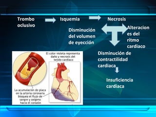 Trombo
oclusivo
Isquemia Necrosis
Disminución de
contractilidad
cardiaca
Insuficiencia
cardiaca
Alteracion
es del
ritmo
cardiaco
Disminución
del volumen
de eyección
 