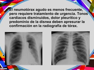 • El neumotórax agudo es menos frecuente,
pero requiere tratamiento de urgencia. Tonos
cardiacos disminuidos, dolor pleurítico y
predominio de la disnea deben apresurar la
confirmación en la radiografía de tórax.
 