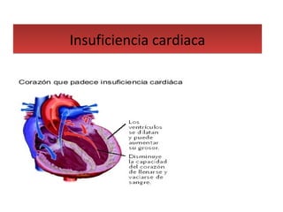 Insuficiencia cardiacaInsuficiencia cardiaca
 