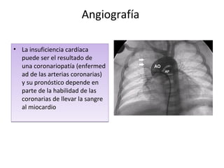 Angiografía
• La insuficiencia cardíaca
puede ser el resultado de
una coronariopatía (enfermed
ad de las arterias coronarias)
y su pronóstico depende en
parte de la habilidad de las
coronarias de llevar la sangre
al miocardio
• La insuficiencia cardíaca
puede ser el resultado de
una coronariopatía (enfermed
ad de las arterias coronarias)
y su pronóstico depende en
parte de la habilidad de las
coronarias de llevar la sangre
al miocardio
 