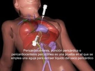 Pericardiocentesis, punción pericárdica o
pericardiocentesis percutánea es una prueba en el que se
emplea una aguja para extraer líquido del saco pericárdico
 