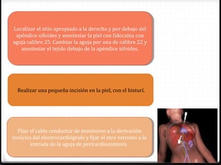 Fijar el cable conductor de monitoreo a la derivación
torácica del electrocardiógrafo y fijar el otro extremo a la
entrada de la aguja de pericardiocentesis.
Fijar el cable conductor de monitoreo a la derivación
torácica del electrocardiógrafo y fijar el otro extremo a la
entrada de la aguja de pericardiocentesis.
Realizar una pequeña incisión en la piel, con el bisturí.
Localizar el sitio apropiado a la derecha y por debajo del
apéndice xifoides y anestesiar la piel con lidocaína con
aguja calibre 25. Cambiar la aguja por una de calibre 22 y
anestesiar el tejido debajo de la apéndice xifoides.
Localizar el sitio apropiado a la derecha y por debajo del
apéndice xifoides y anestesiar la piel con lidocaína con
aguja calibre 25. Cambiar la aguja por una de calibre 22 y
anestesiar el tejido debajo de la apéndice xifoides.
 