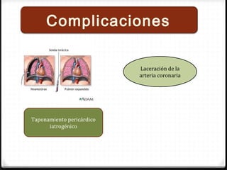 Complicaciones
Laceración de la
arteria coronaria
Taponamiento pericárdico
iatrogénico
 
