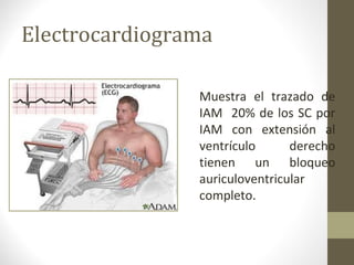 Electrocardiograma
Muestra el trazado de
IAM 20% de los SC por
IAM con extensión al
ventrículo derecho
tienen un bloqueo
auriculoventricular
completo.
 