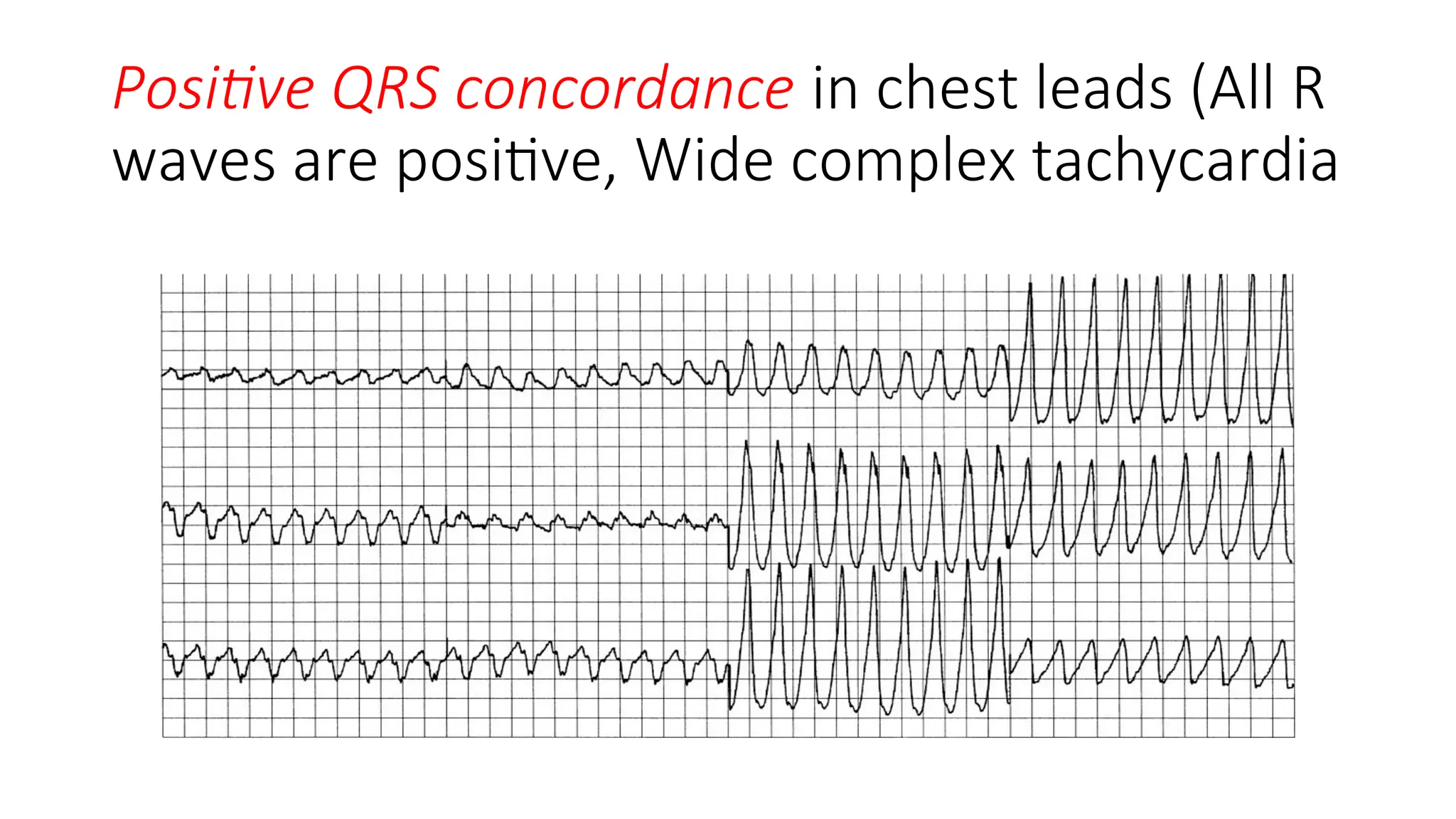 Positive QRS concordance in chest leads (All R
waves are positive, Wide complex tachycardia
 