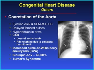 Congenital Heart Disease Others Coarctation of the Aorta CXR Loss of aortic knob Rib notching due to collateral recruitment Increased circle-of-Willis berry aneurysms (CVA) Bicuspid AoV – 40-60% Turner’s Syndrome Ejection click & SEM at LLSB Delayed femoral pulses Hypertension in arms 