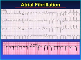 Atrial Fibrillation 