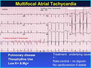 Multifocal Atrial Tachycardia Pulmonary disease Theophylline Use Low K+ & Mg+ Treatment:  underlying cause + : Rate control – no digoxin No cardioversion if stable 