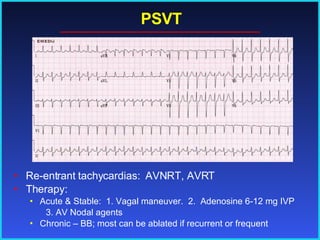 PSVT Re-entrant tachycardias:  AVNRT, AVRT Therapy: Acute & Stable:  1. Vagal maneuver.  2.  Adenosine 6-12 mg IVP 3. AV Nodal agents Chronic – BB; most can be ablated if recurrent or frequent 