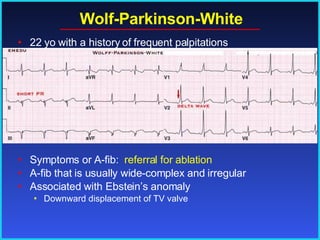 Wolf-Parkinson-White Symptoms or A-fib:  referral for ablation A-fib that is usually wide-complex and irregular Associated with Ebstein’s anomaly Downward displacement of TV valve 22 yo with a history of frequent palpitations 