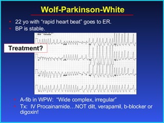 Wolf-Parkinson-White A-fib in WPW:  “Wide complex, irregular” Tx:  IV Procainamide…NOT dilt, verapamil, b-blocker or digoxin! 22 yo with “rapid heart beat” goes to ER. BP is stable. Treatment? 