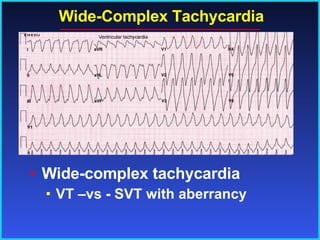 Wide-Complex Tachycardia Wide-complex tachycardia VT –vs - SVT with aberrancy 