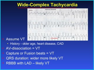 Wide-Complex Tachycardia Assume VT History - older age, heart disease, CAD AV-dissociation = VT Capture or Fusion beats = VT QRS duration: wider more likely VT RBBB with LAD – likely VT 