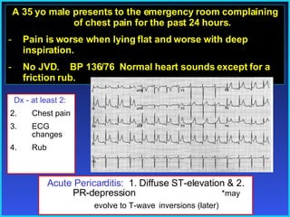 A 35 yo male presents to the emergency room complaining of chest pain for the past 24 hours. Pain is worse when lying flat and worse with deep inspiration. No JVD.  BP 136/76  Normal heart sounds except for a friction rub.  Acute Pericarditis:  1. Diffuse ST-elevation & 2. PR-depression  *may evolve to T-wave   inversions (later) Dx - at least 2:  Chest pain ECG changes Rub 