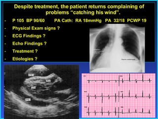 Despite treatment, the patient returns complaining of problems “catching his wind”. P 105  BP 90/60  PA Cath:  RA 18mmHg  PA  32/18  PCWP 19 Physical Exam signs ? ECG Findings ? Echo Findings ? Treatment ? Etiologies ? 