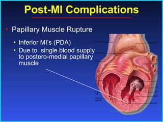 Post-MI Complications Papillary Muscle Rupture  Inferior MI’s (PDA) Due to  single blood supply to postero-medial papillary muscle 