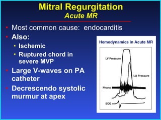 Mitral Regurgitation Acute MR Also:  Ischemic Ruptured chord in severe MVP Large V-waves on PA catheter Decrescendo systolic murmur at apex Most common cause:  endocarditis 