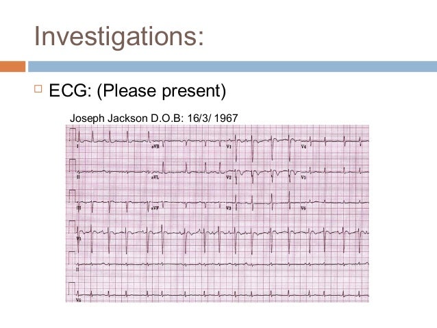 regular irregular heartbeat regular irregular heartbeat
