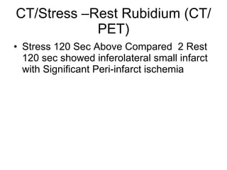 CT/Stress –Rest Rubidium (CT/PET) Stress 120 Sec Above Compared 2 Rest 120 sec showed inferolateral small infarct with Significant Peri-infarct ischemia
