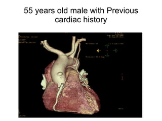 55 years old male with Previous cardiac history
