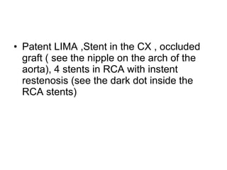 Patent LIMA ,Stent in the CX , occluded graft ( see the nipple on the arch of the aorta), 4 stents in RCA with instent restenosis (see the dark dot inside the RCA stents)