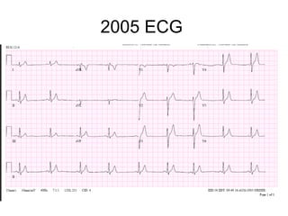 2005 ECG