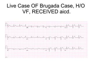 Live Case OF Brugada Case, H/O  VF, RECEIVED aicd. 