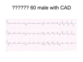 ?????? 60 male with CAD 