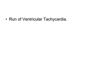 Run of Ventricular Tachycardia. 