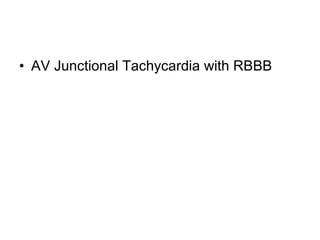 AV Junctional Tachycardia with RBBB 