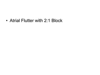 Atrial Flutter with 2:1 Block 