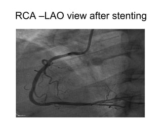RCA –LAO view after stenting
 