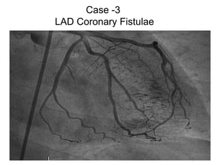 Case -3
LAD Coronary Fistulae
 