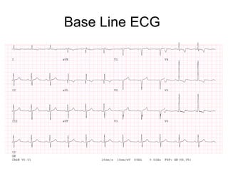 Base Line ECG
 