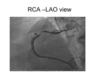 RCA –LAO view
 