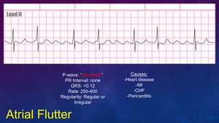 Atrial Flutter
P-wave: “saw-tooth”
PR Interval: none
QRS: <0.12
Rate: 250-400
Regularity: Regular or
Irregular
Causes:
-He...