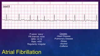 Atrial Fibrillation
P-wave: ‘wavy’
PR Interval: none
QRS: <0.12
Rate: >400
Regularity: irregular
Causes:
-Heart Disease
-P...