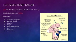 LEFT-SIDED HEART FAILURE
Left side of the heart cannot move blood forward to the body.
Blood is backing up in the LUNGS.
A...
