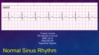 Normal Sinus Rhythm
P-wave: normal
PR Interval: 0.12-0.20
QRS: <0.12
Rate: 60-100
Regularity: Regular
 