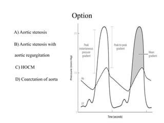Option
A) Aortic stenosis
B) Aortic stenosis with
aortic regurgitation
C) HOCM
D) Coarctation of aorta
 