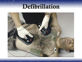 Defibrillation
 