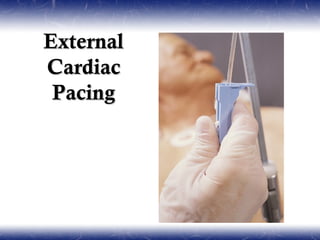 External
Cardiac
 Pacing
 