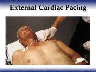 External Cardiac Pacing
 