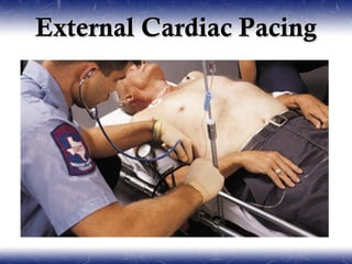 External Cardiac Pacing
 