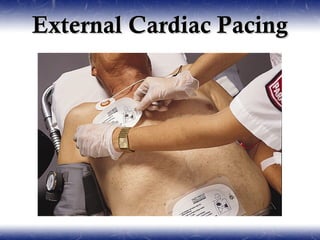 External Cardiac Pacing
 