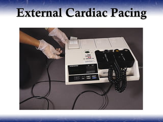 External Cardiac Pacing
 