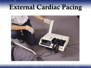 External Cardiac Pacing
 